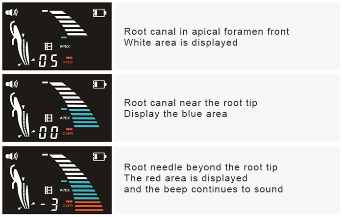 Canal radicular endodoncia Vdw Raypex 5 El mejor pantalla táctil den tal Apex Locator