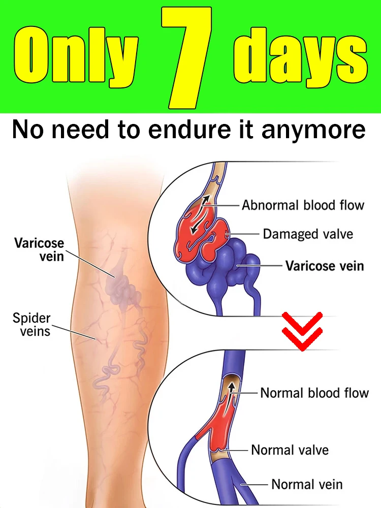 

Rᴇᴍᴏᴠᴇ ᴠᴀʀɪᴄᴏsᴇ ᴠᴇɪɴs, sᴀғᴇ ᴀɴᴅ ᴇғғᴇᴄᴛɪᴠᴇ, ᴛʀᴇᴀᴛ ᴠᴀʀɪᴄᴏsᴇ ᴠᴇɪɴs