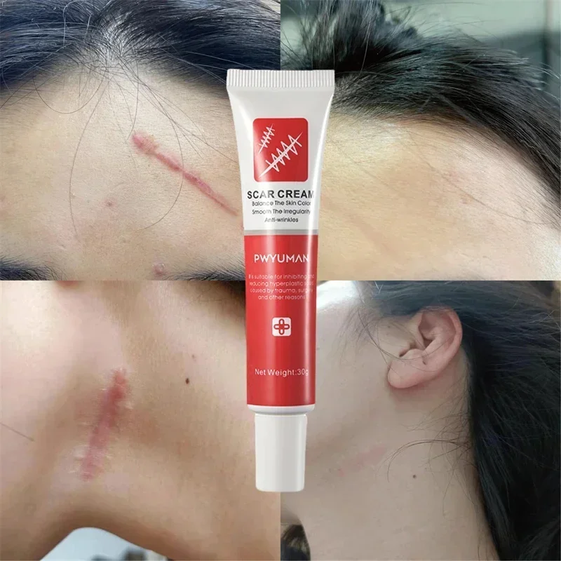 Effective Scar Removal Cream Treatment Stretch Marks Acne Scars Repair Gel Burn Surgical Scars Whitening Moisturizing Skin Care