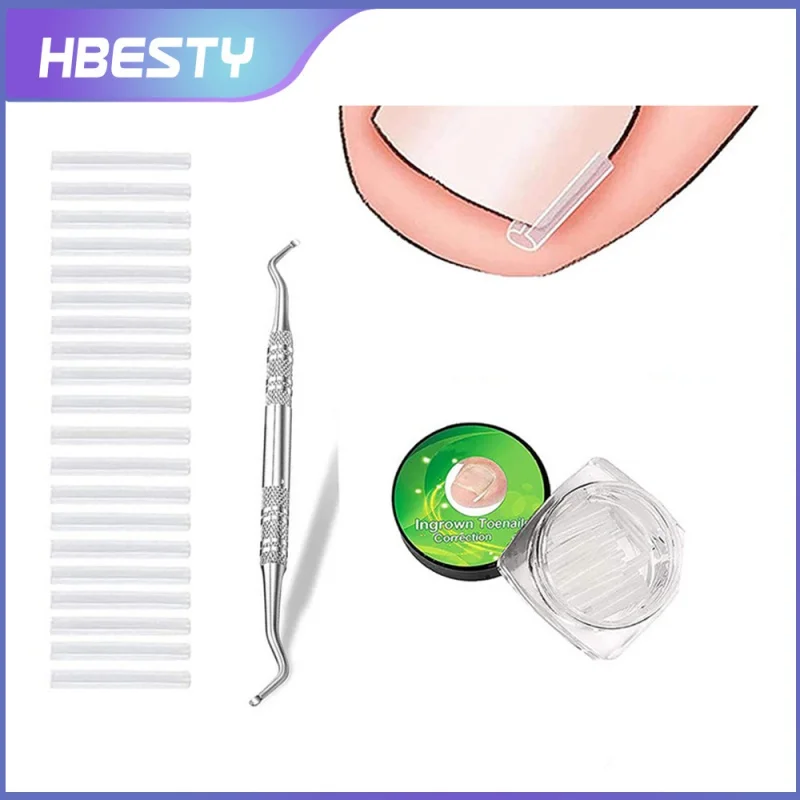 

HBESTY Ingrown Toenail Correction Tool Invisible Ingrown Toe Nail Treatment Pad Groove Straightening Clip Brace Foot Care Tool