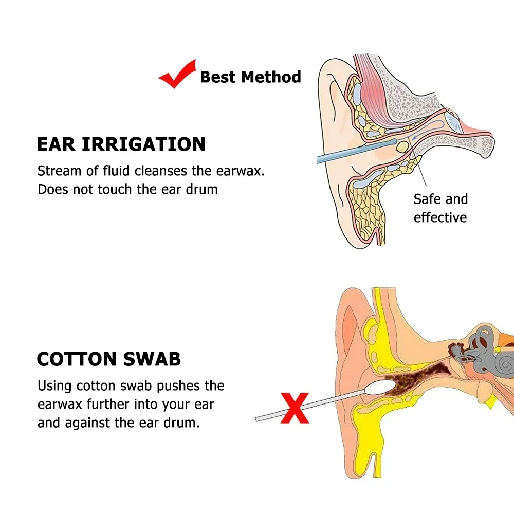 500 Ml Ear Cleaning Irrigation Kit Ear Wax Removal Tool Water Washing Syringe Squeeze Bulb Ear Cleaner for Adults Kids Earwax