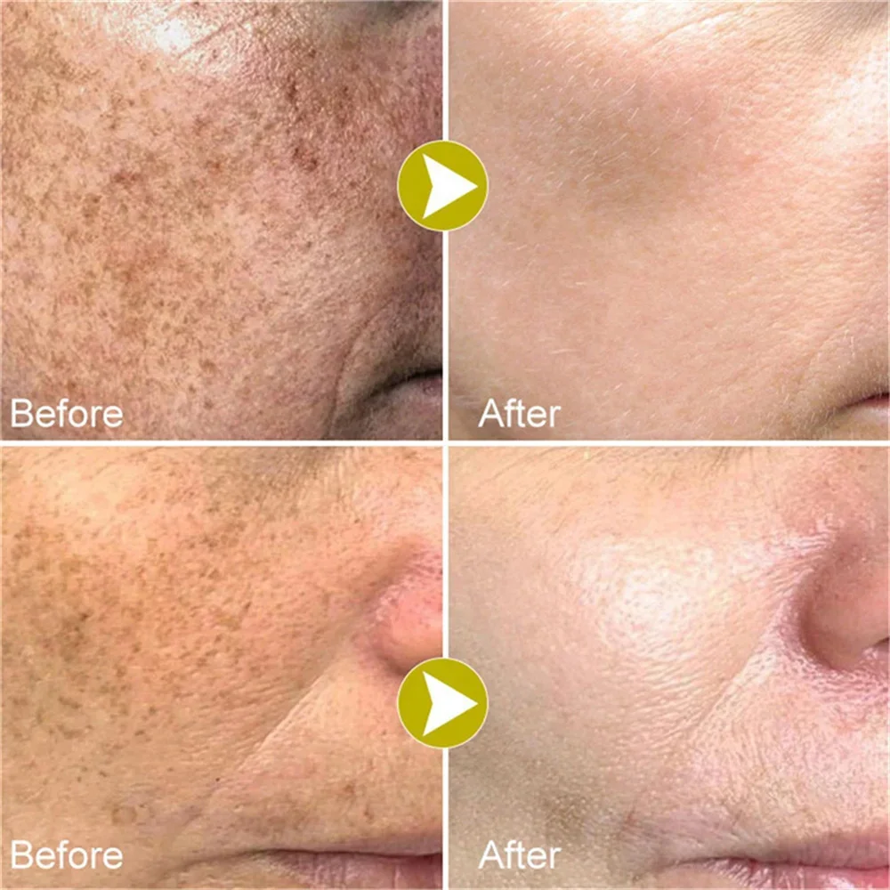 Lightening Melasma Skin Care Cream Removal Dark Pigment Brighten Face Cream Nicotinamide Brighten Fade Melanin Chloasma Emulsion