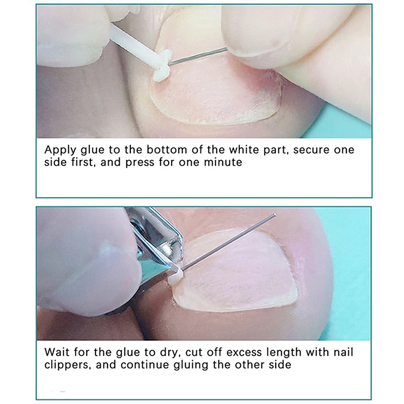 ペディキュア、埋め込み式つま先ネイルトリートメント用のingrown toenailは、プロのingrown toenail補正、フットケアツール