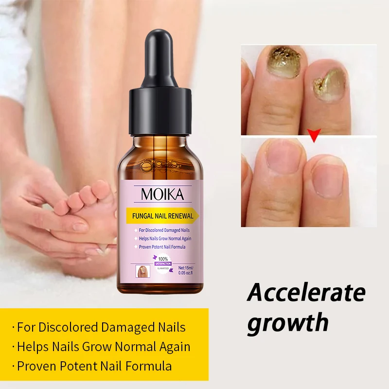 MOIKA Fungal Nail Treatment Serum Foot Nail Fungus Removal Repair Gel Anti Infection Paronychia Onychomycosis Foot Nails Care