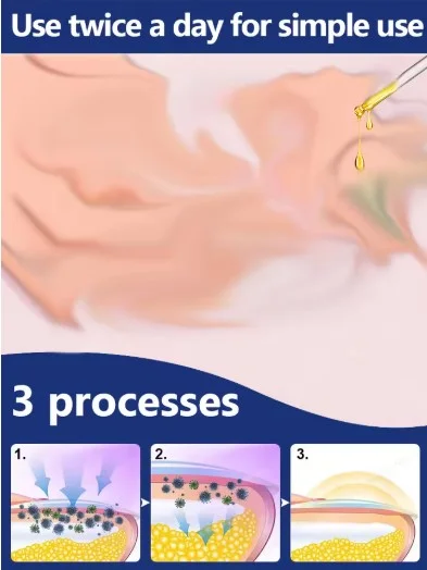 ซ่อมแซมเล็บที่เป็นเชื้อราอย่างรวดเร็ว โรคเล็บมือเล็บเท้าจากเชื้อรา ป้องกันเล็บเท้า แผ่นปิดแผลแบบยึดติดเอง