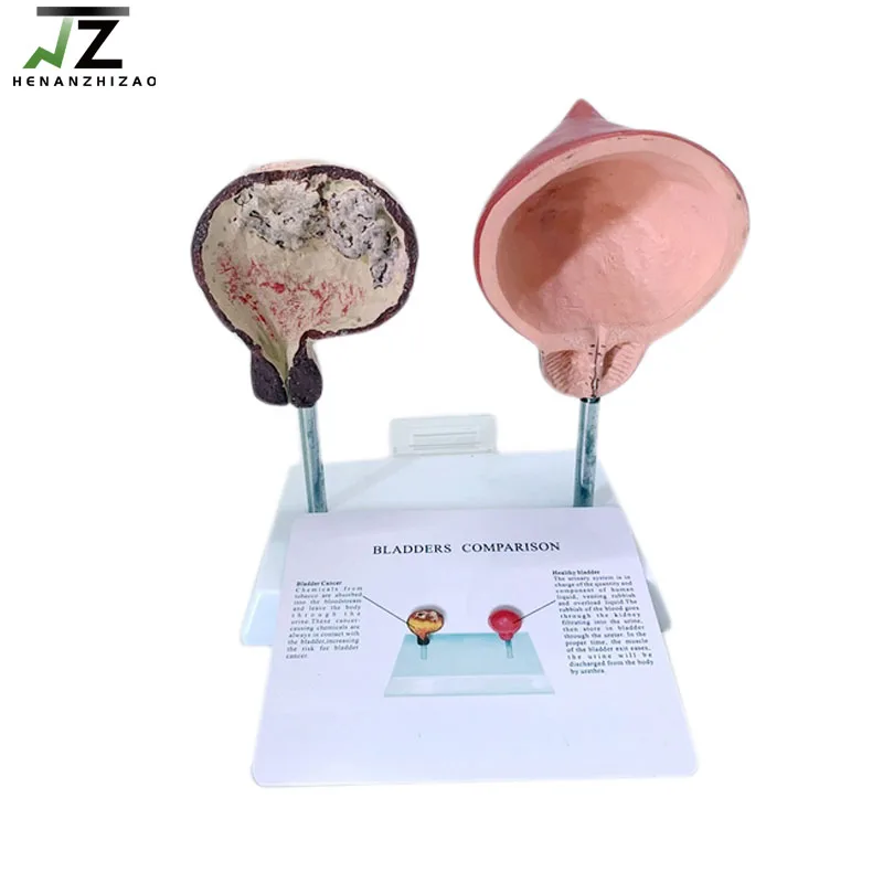 

Reproductive System Human Healthy and Smoking Bladder Anatomy Pathological Model