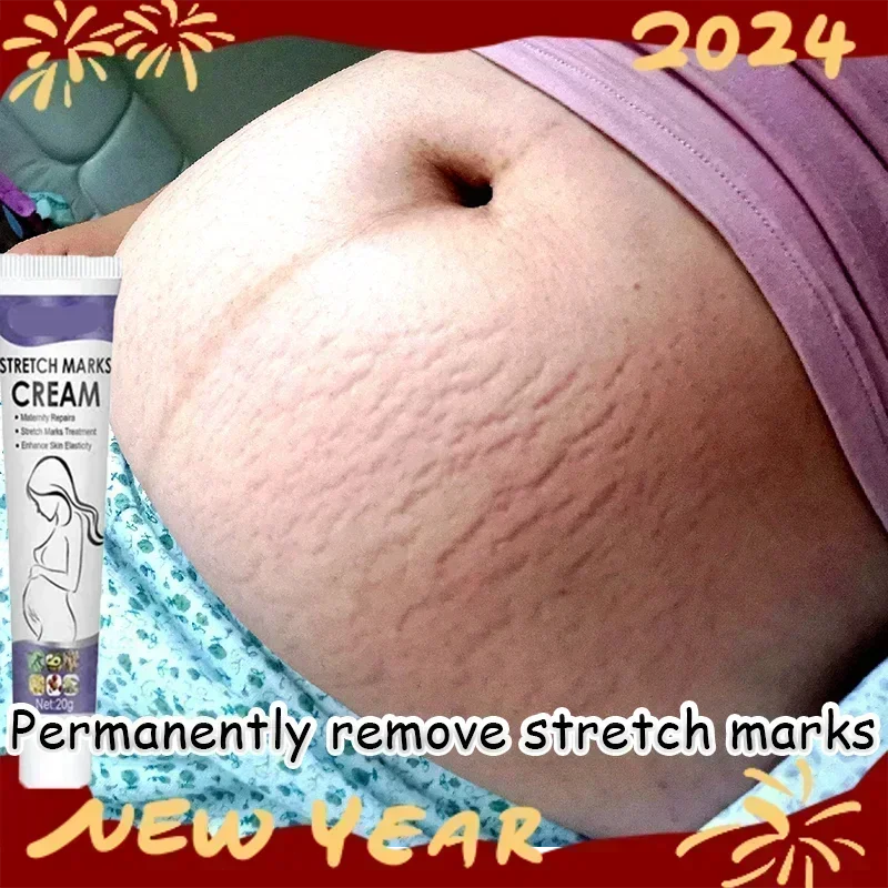 HOT~Eliminate Red White Old Stretch Marks Cream For Pregnancy Postpartum Skin Care Gel