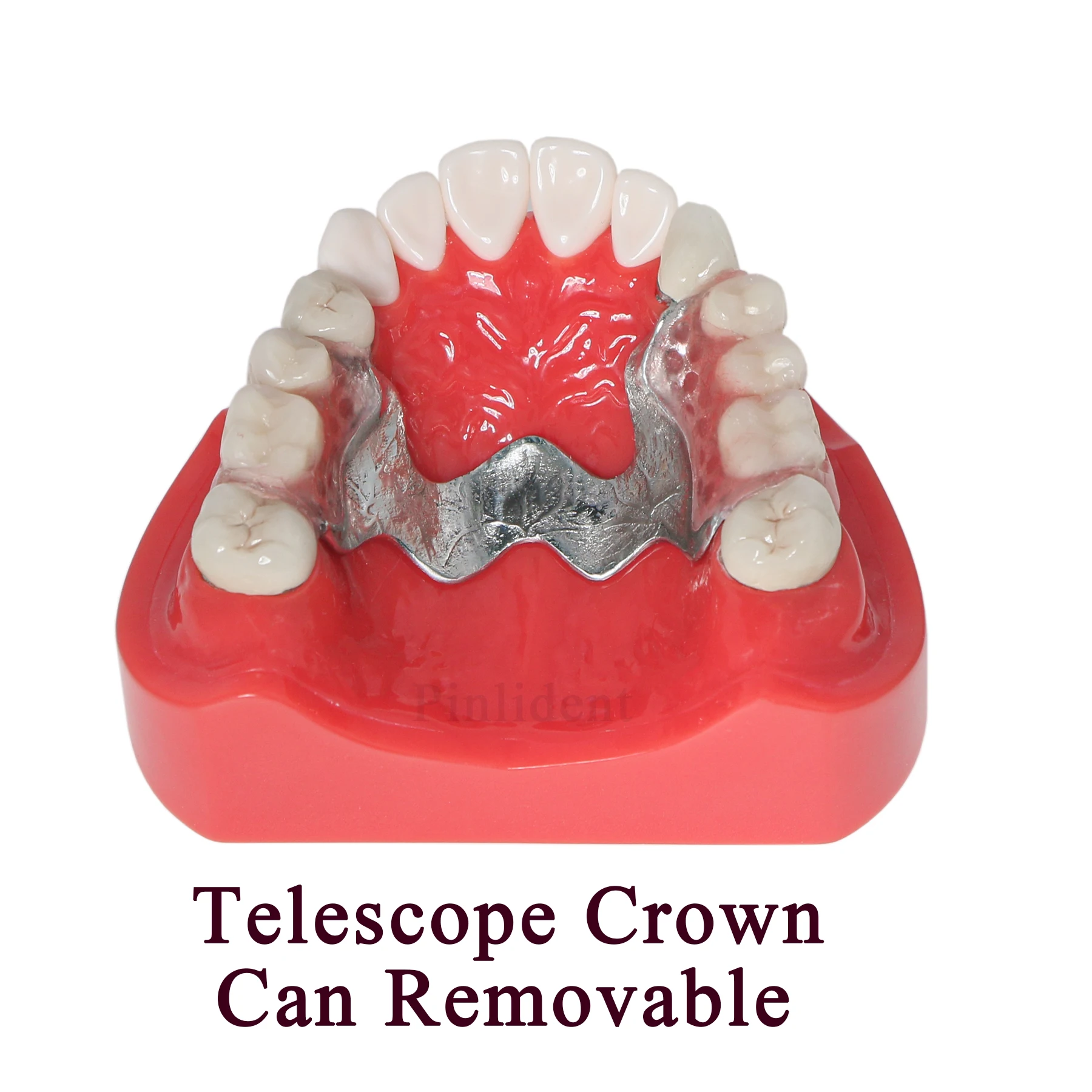 Dental Typodont Restoration Teeth Implant Model Telescope Crown  Orthodontic Restoration Model M6010