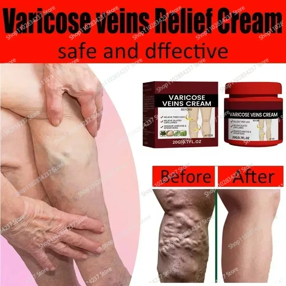 Effective Varicose Vein Relief To Relieve Vasculitis Phlebitis Spider Pain Foot Care