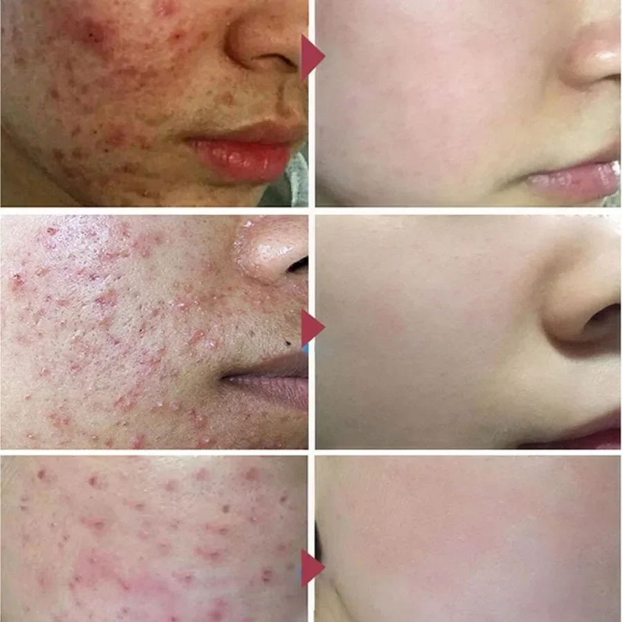 Effective Acne Removal Cream Herbal Acne Spots Oil Control Acne Scar Cream Removal Whitening Moisturizing Face Gel Skin Care 20g