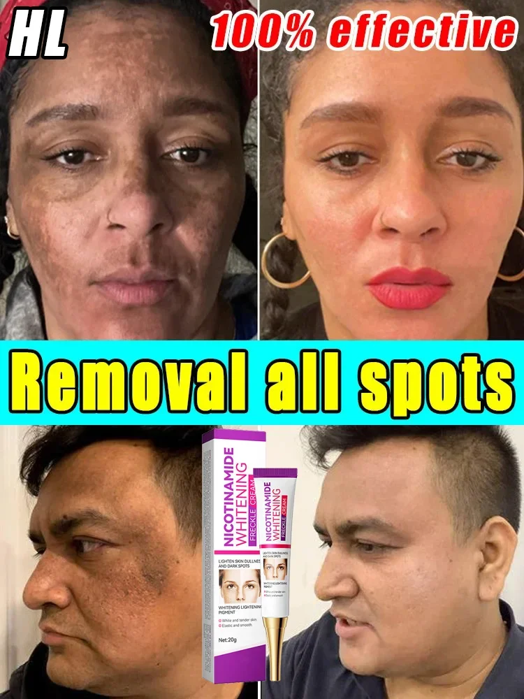 

Freckles Remover Cream Removal Dark Spots Cream Fade Whitening Face Melasma Cream Nicotinamide Brightening Moisturizing Emulsion