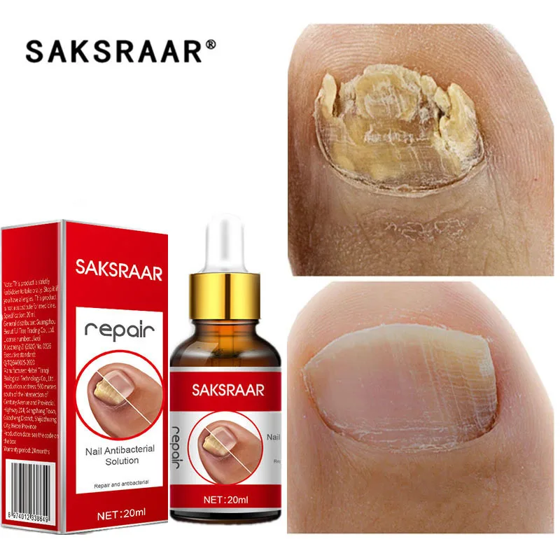 Nail Fungal Treatment Feet Care Essence Nail Foot Whitening Toe Nail Fungus Removal Gel Anti Infection Paronychia Onychomycosis