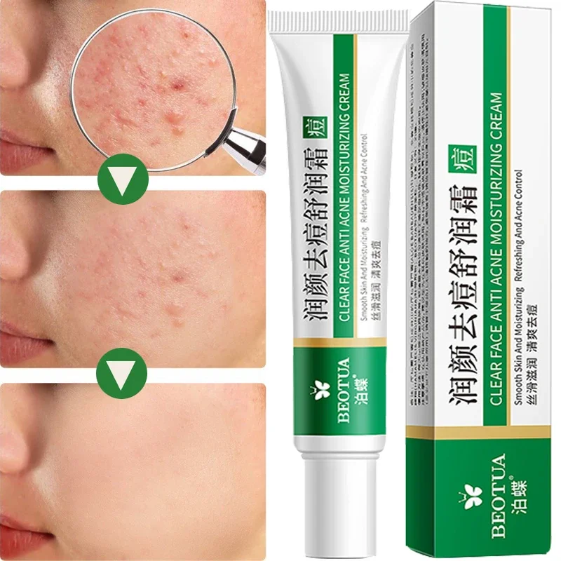 Acne Treatment Cream Face Skin Care Effective Herbal Black Dots Acne Pimple Mark Remover Anti-aging Moisturizin Whitening Cream