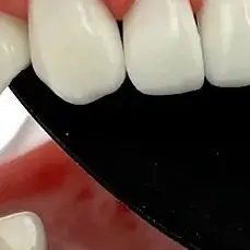 

Autoclavable Dental Black Background Plate Contrast Plate Photographic Oral Cheek Palate Contrast Plate Tools