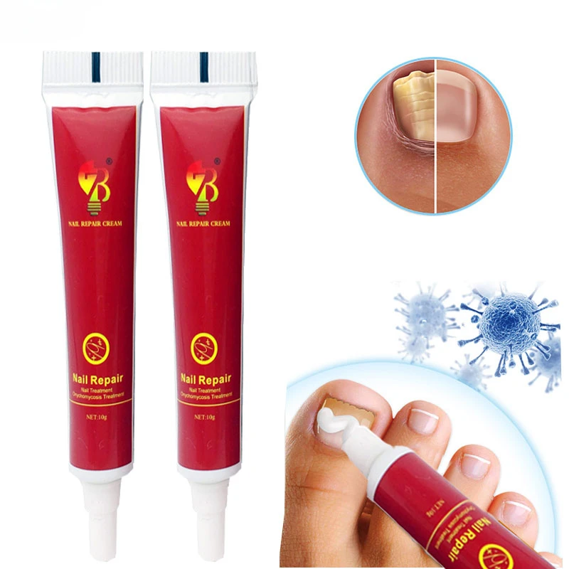 

1Pcs Nail Fungus Removal Cream Onychomycosis Fungal Nail Treatment Paronychia Anti Infection Feet Toe Fungal Nail Care Ointment