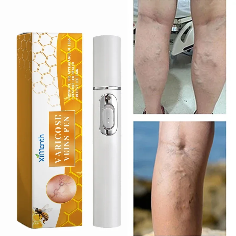 3Pcs Varicose Veins Laser Therapy Pen Improves Varicose Vein Cream For Men And Women Relieve Leg Pain Improve Blood Circulation