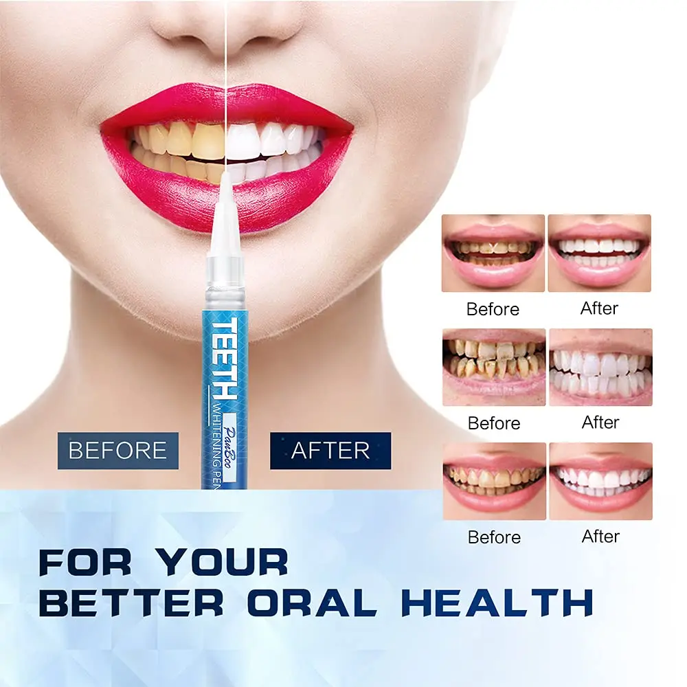 Teeth Whitening Pen Remove Coffee,Tea,Smoke Stains Freshen Breath Easy Application Fast-Acting Teeth Brightening Pen