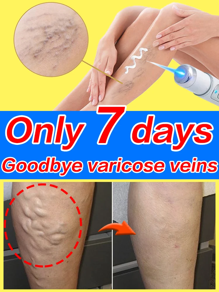 Narzędzia do pielęgnacji nóg zmniejszają niekomfort w nogach, poprawiają krążenie krwi, produkty do pielęgnacji żylaków z niebieskim światłem