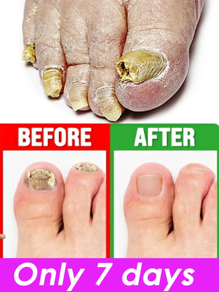 

Fungal Nail Treatment Serum Spray Foot Nail Fungus Removal Repair Gel Anti Infection Paronychia Onychomycosis Foot Nails Care