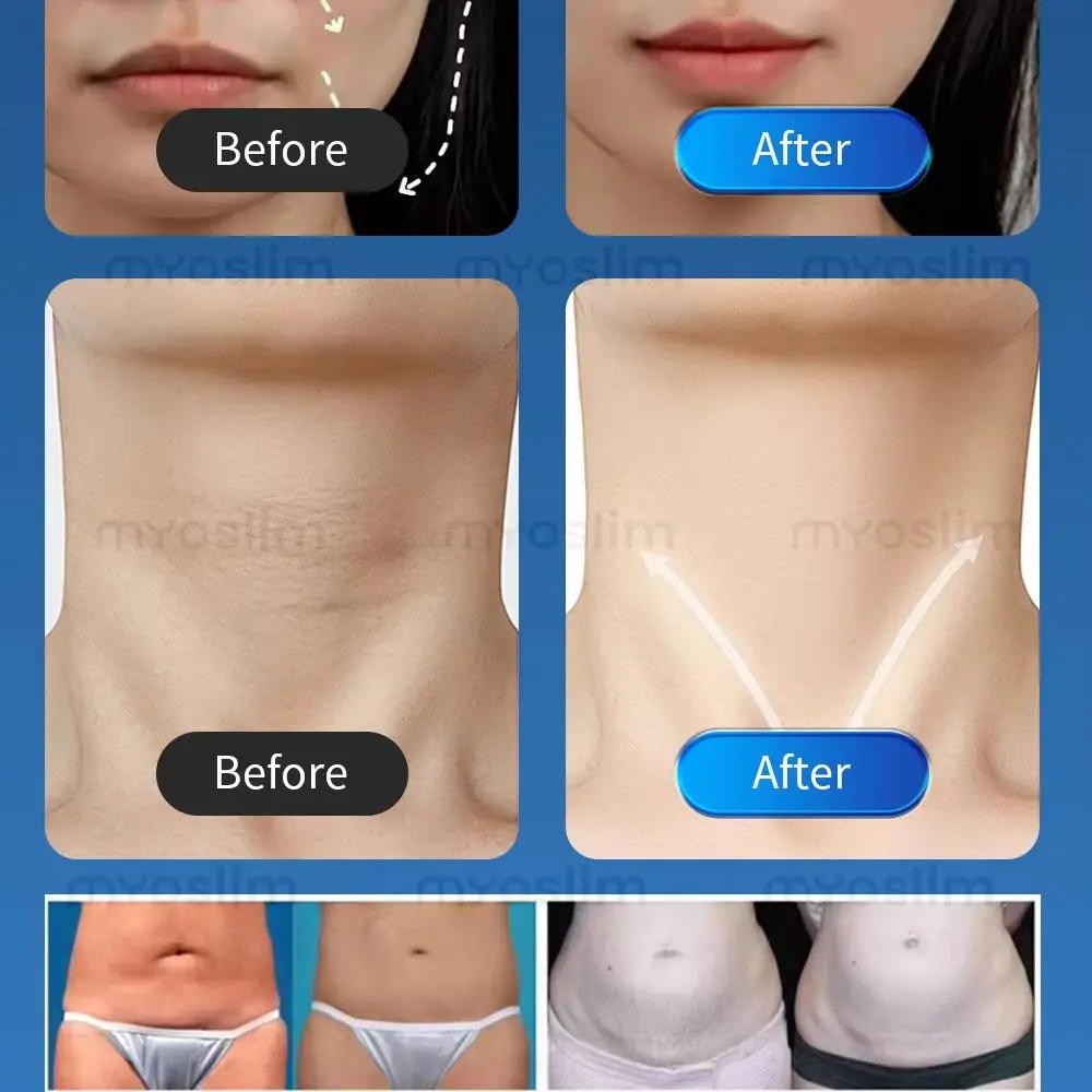 

Myoslim PRO Body Sculpt Machine 15 Tesl 6500W emt Lose Weight RF Body Slim Muscle Stimulation Professional Machine