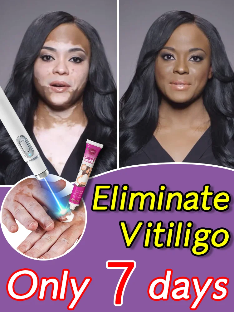 

Laser removal of vitiligo