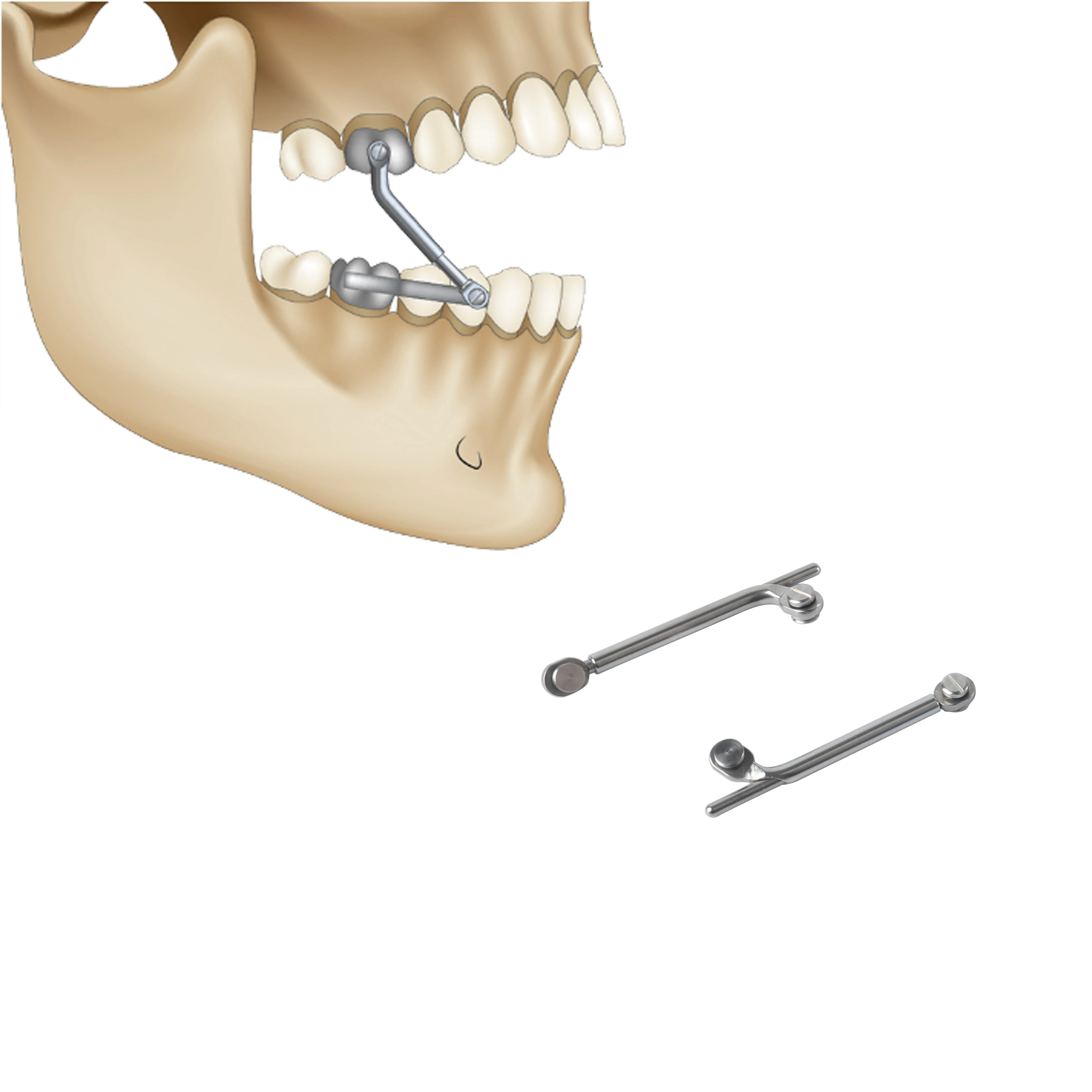 

Orthodontic Herbst Appliance Stainless Steel Banded with Bite Corrector for Class II Malocclusion, Dental Lab Direct Supply
