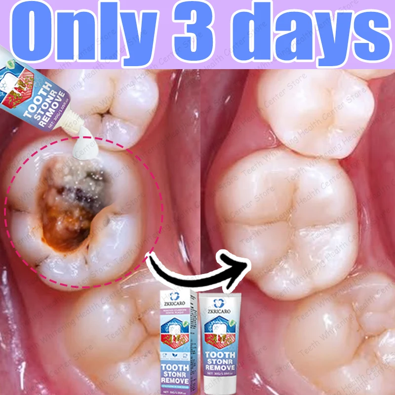 99 % der wiederverkauften Menschen, um Zahnkaries zu reparieren, Zähne reinigen