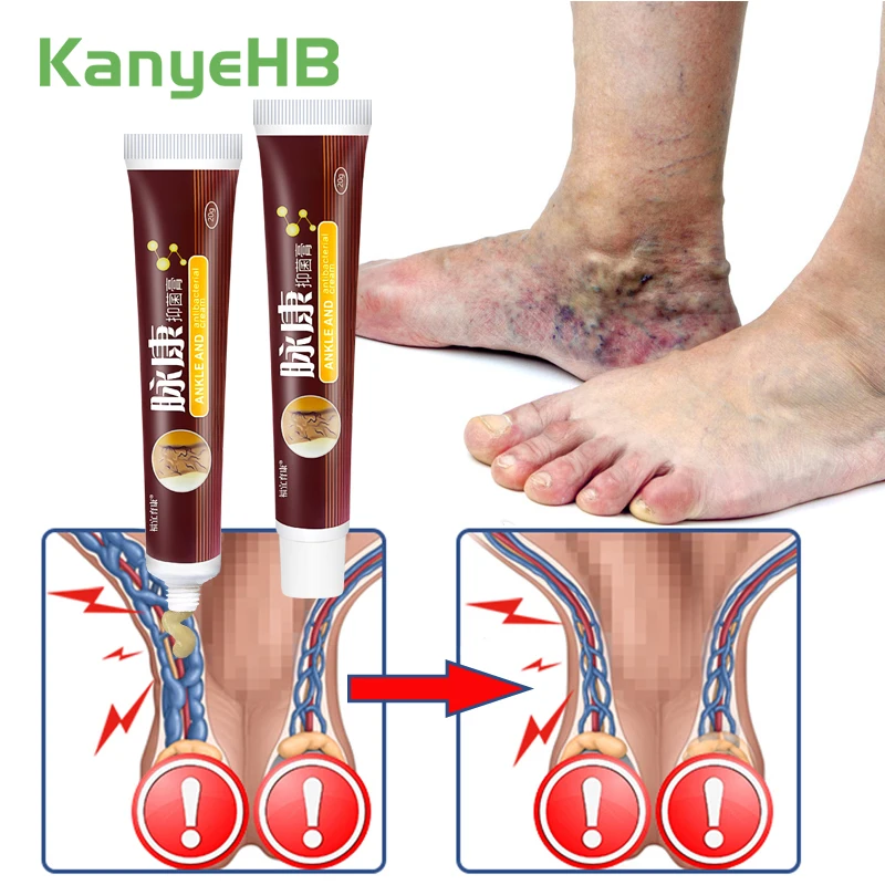 

2Pcs Chinese Natural Herbal Medicine For Treating Varicose Vascular Inflammation Massage Cream Cure Varicose Vein Ointment A428