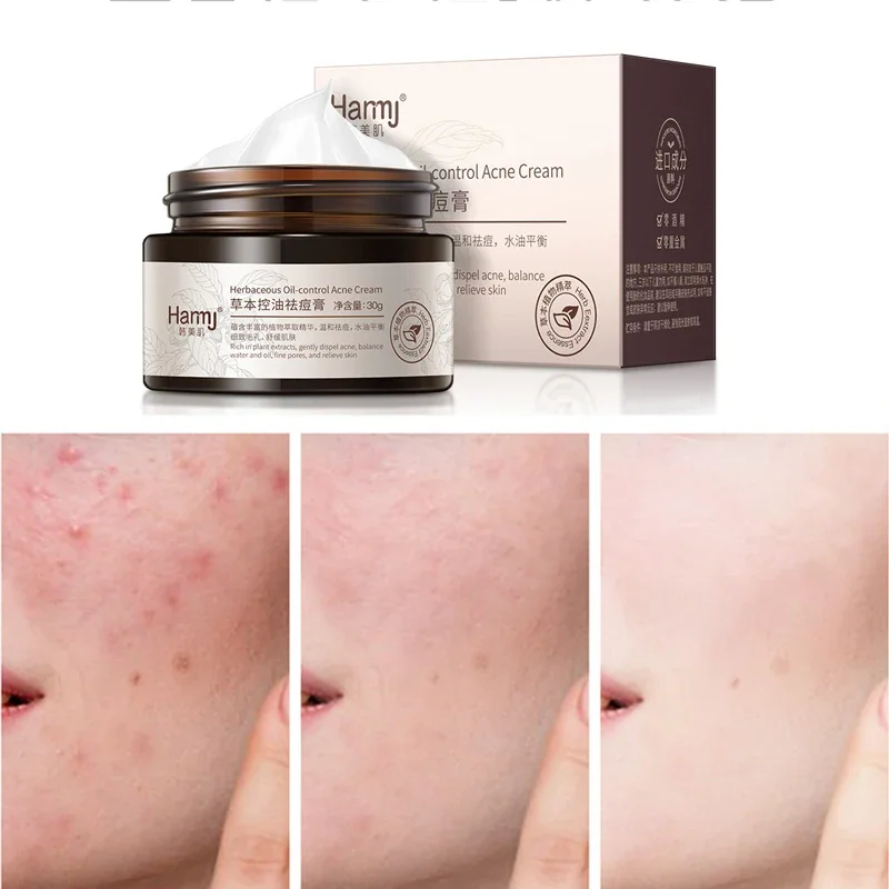 

Freckle cream acne removing cream plant extract to eliminate acne marks suitable both men women Whitening moisturizing skin care