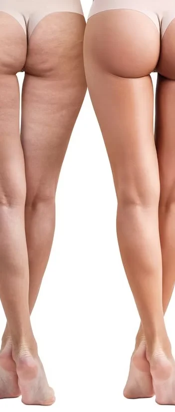 Professional Spa Use 9D Roller Massager Machine for Lymphatic Drainage Cellulite Removal Body Sculpting Butt Lifting