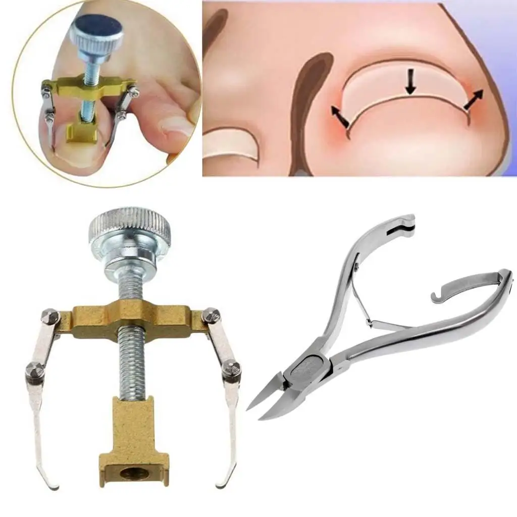 Ingrown Toe Nail Fixer Pedicure Toenail Orthotic Bunion Treatment