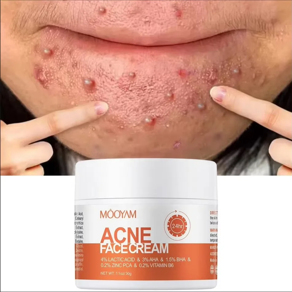 

Herbal Acne Treatment Cream Anti Acne Face Cream Pimple Removal Spots Oil Control Shrink Pores Moisturizing Skin Care Cream