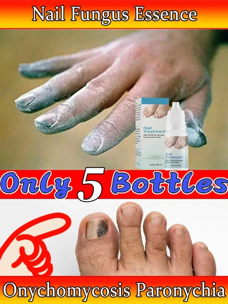 Soro do fungo do prego, líquido do reparo do pé, Toe Nail Fungus Remoção Gel, Anti infecção, Paronychia, Onicomicose