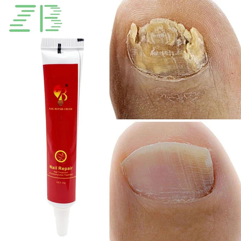 

Original Nail Fungus Treatment 7DAYS Repair Feet Care Essence Anti Infection Onychomycosis Foot Toe Nail Fungal Removal Cream