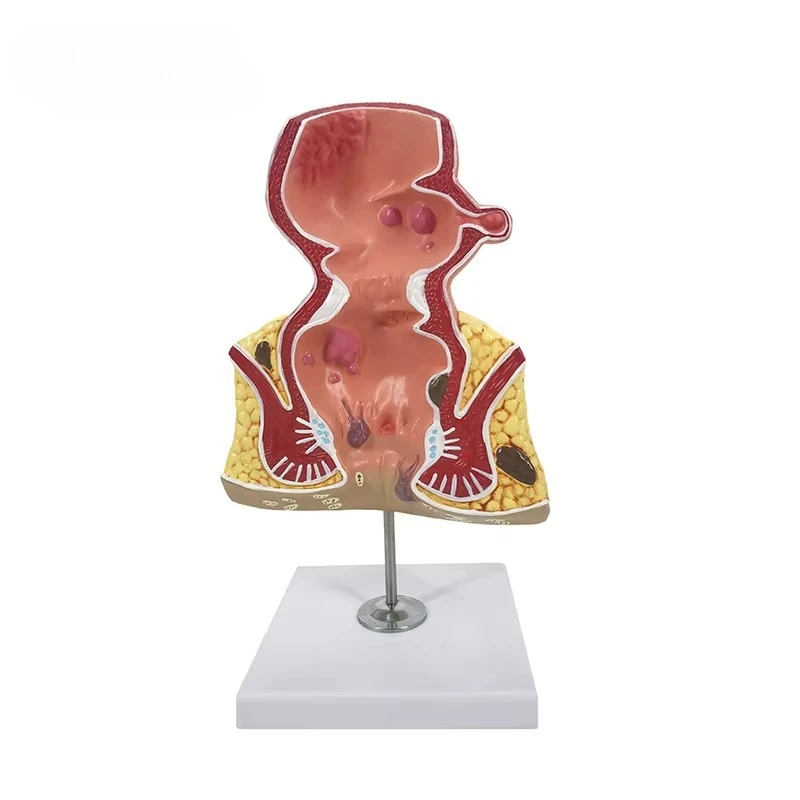 

Rectal anatomy model and pathological rectal disease medical demonstration
