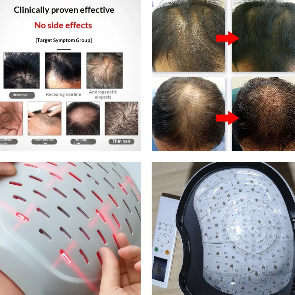 

Laser Cap for Thinning Hair & Baldness, 650nm LLLT 6750mW Hair Growth Therapy Device, Low Level Laser with 90+210 Beams Regrowth