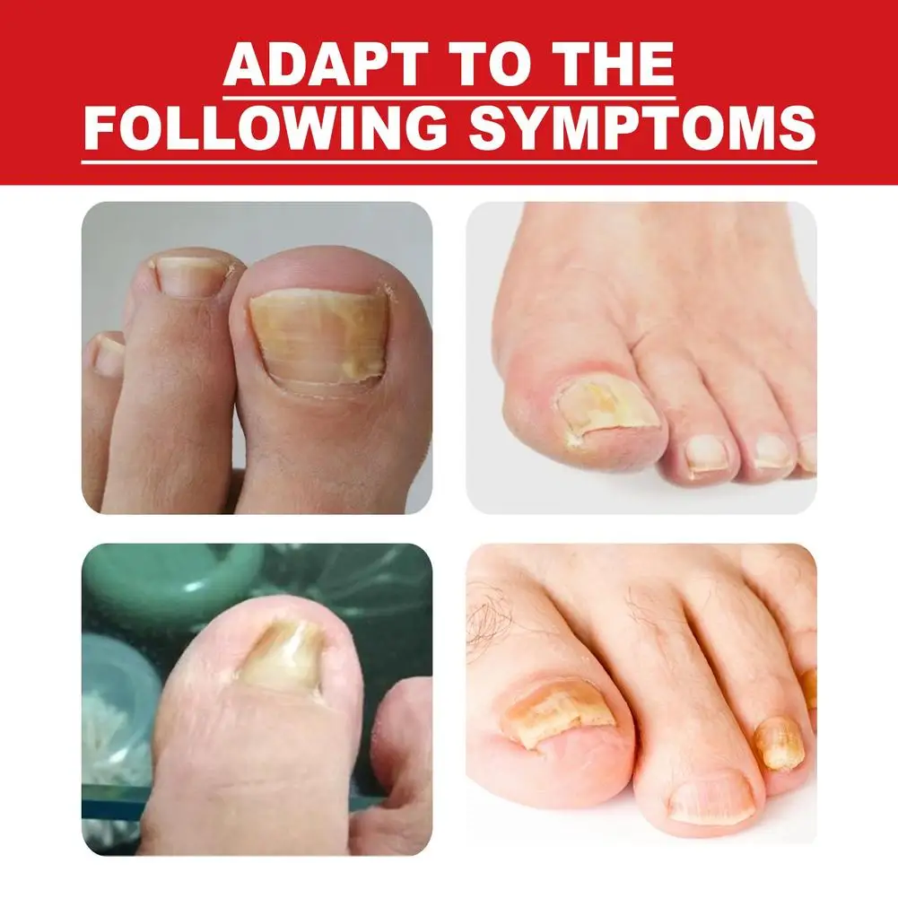 Dispositivo do tratamento do laser do fungo do prego, Essência do cuidado dos pés, Anti infecção Paronychomycosis encravado Toenail