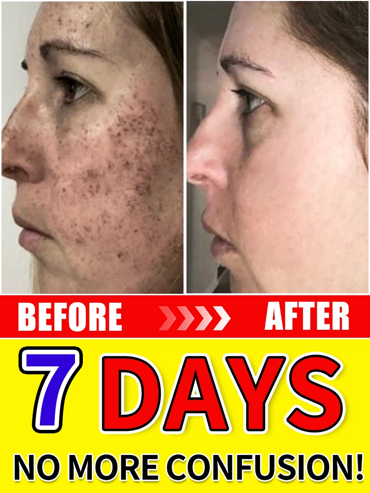 

Powerful Cream Fast Skin Lightening Solve Melasma Dark Spots