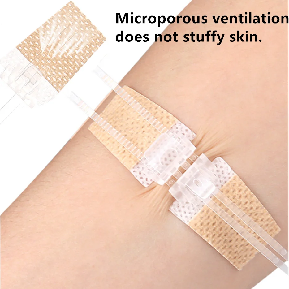 Emergency Laceration Closures Suture-free Zipper Tie Wound Closure Patch Hemostatic Patch Wound Fast Suture Zipper Wound Closure