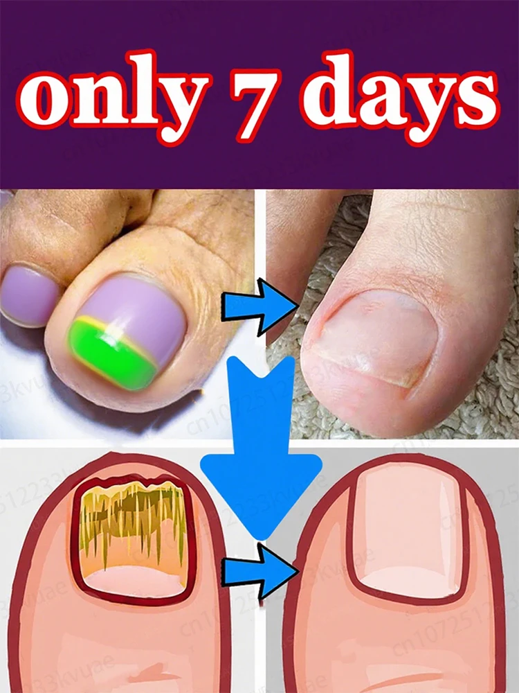 Pʟᴀɴᴛ-ʙᴀsᴇᴅ ɪɴɢʀᴇᴅɪᴇɴᴛs, sᴀʏ ɢᴏᴏᴅʙʏᴇ TO ɴᴀɪʟ ғᴜɴɢᴜs