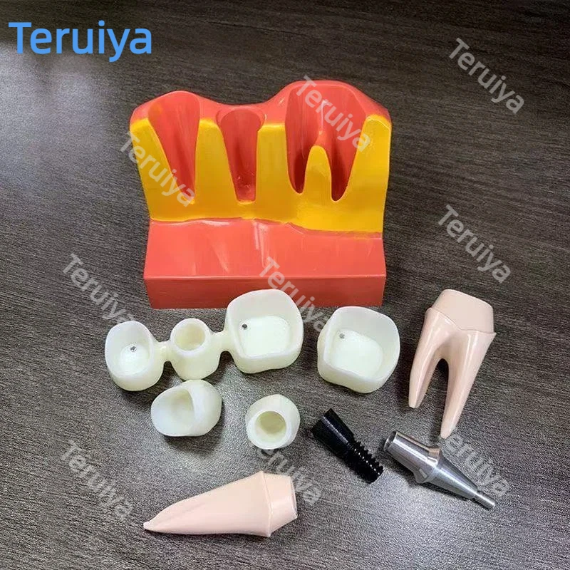 Oral Dental Implant Demonstrator, 4 Times Magnified Model with Detachable Implant Screw & Crown