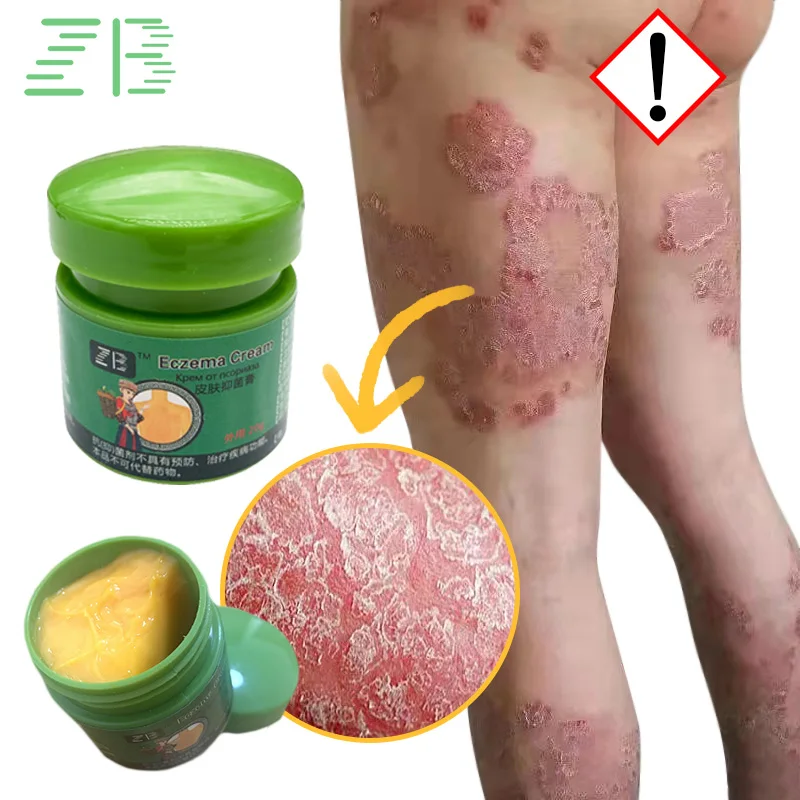 Pomada médica para Psoriasis, crema para Dermatitis alérgica, Eczema, crema para pápulas, infección por hongos, tratamiento de apósito, 20g