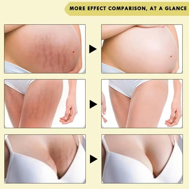 100ml Stretch Mark Removal Oil Removes Postpartum Pregnant Women Scar Repair Obesity Stretch Mark Anti-Aging Firming Serum Cream