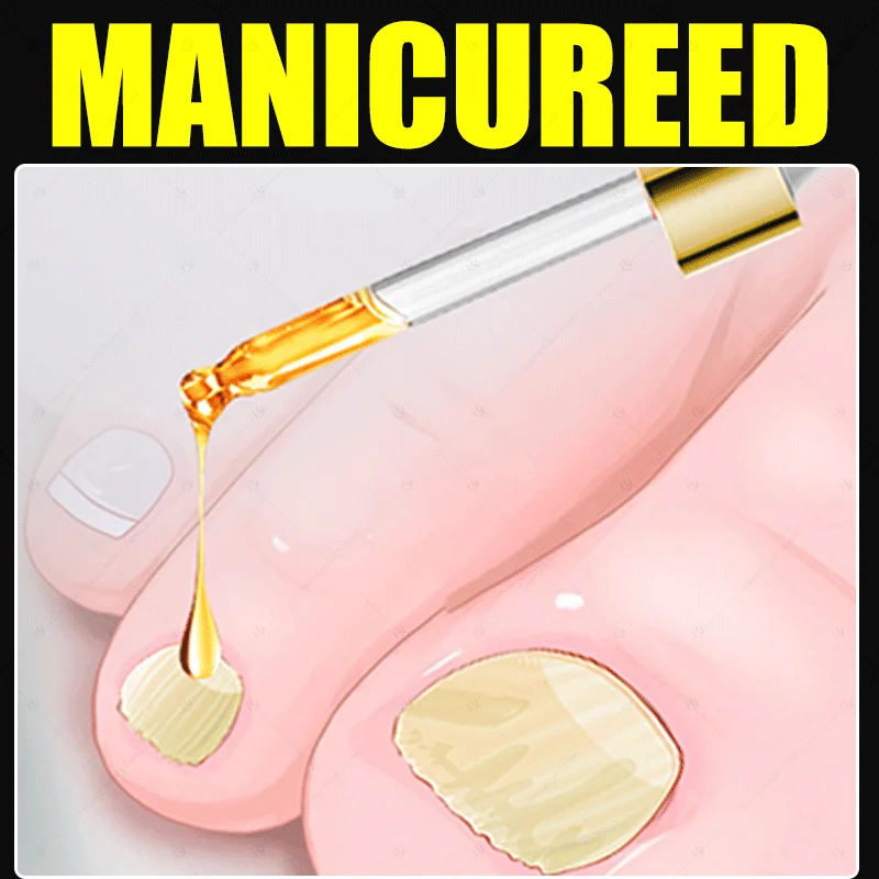 

AHSOHASFC NAIL NAONV5 FUNGUS 5ASBUCJ