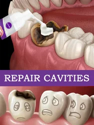 Caries dentales curativas, anticaries