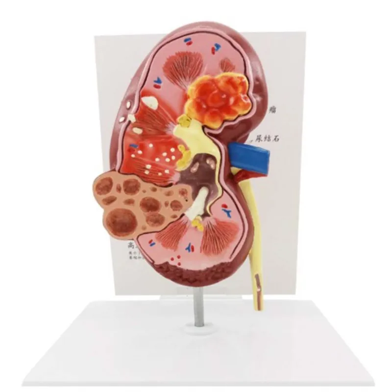 Lesion Kidney Model Human Anatomy Organ Medical Teaching Supplies