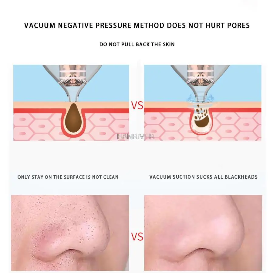 Odkurzacz do twarzy z czarnymi kropkami, usuwacz trądziku i zaskórników, odkurzacz do czarnych kropel, oczyszczacz porów, narzędzia do pielęgnacji skóry.