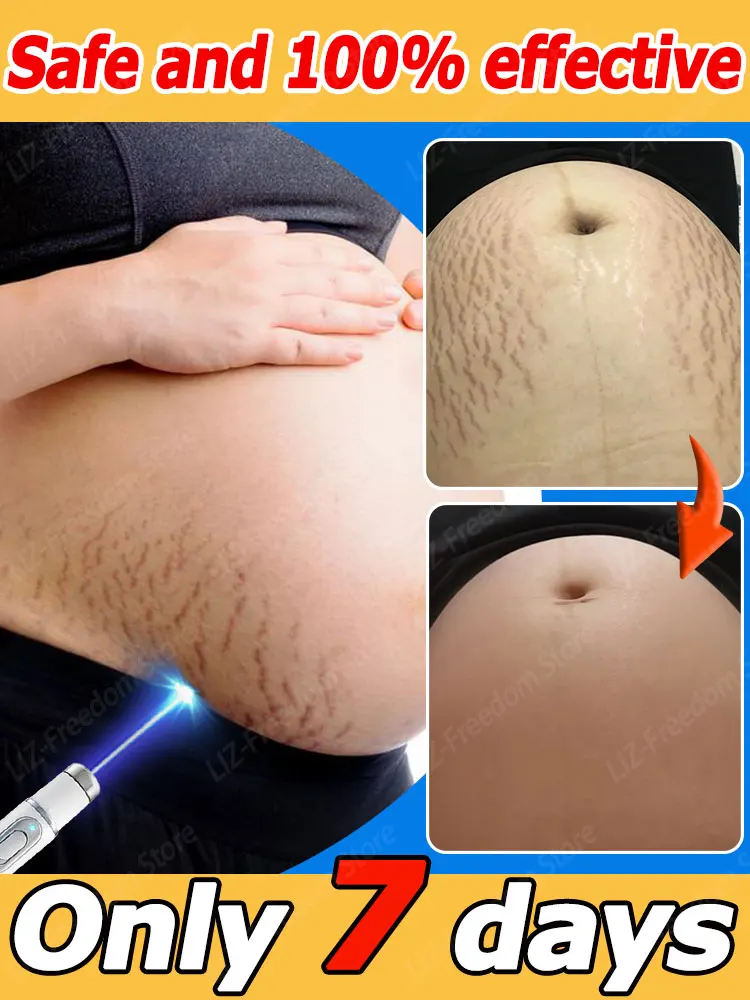 Pregnancy Stretch Marks Efficient Eliminate Red White Old Surgical Cream