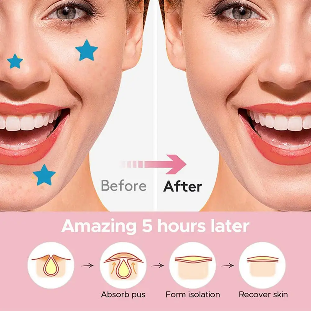 Kleurrijk Hart/Ster Acne Patch Zacht en Niet-irriterend Vervaagt Acne En Sluit Puistje Verwijdering Stickers Onzichtbare Acne Zorg Patch