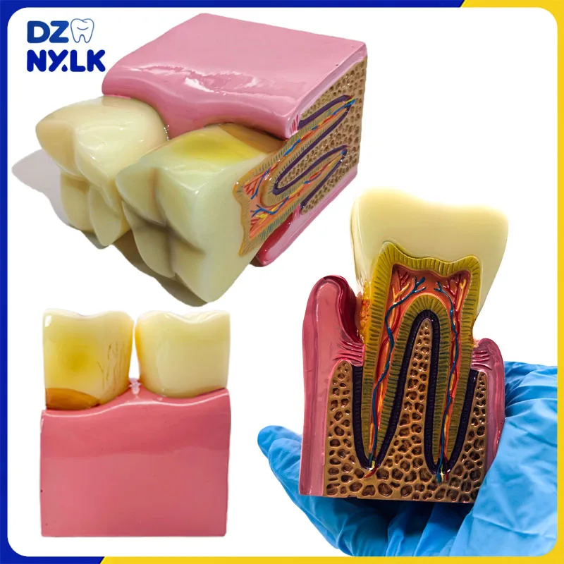 

8 тонн зубного кариеса, модель зубов, перидонтит, чехол, анализ, модель зубов для стоматологической демонстрации, стоматологическая лаборатория, исследование полости рта